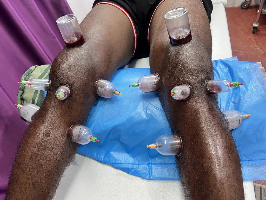 Rashid Hijama cupping Services, Johannesburg South Africa