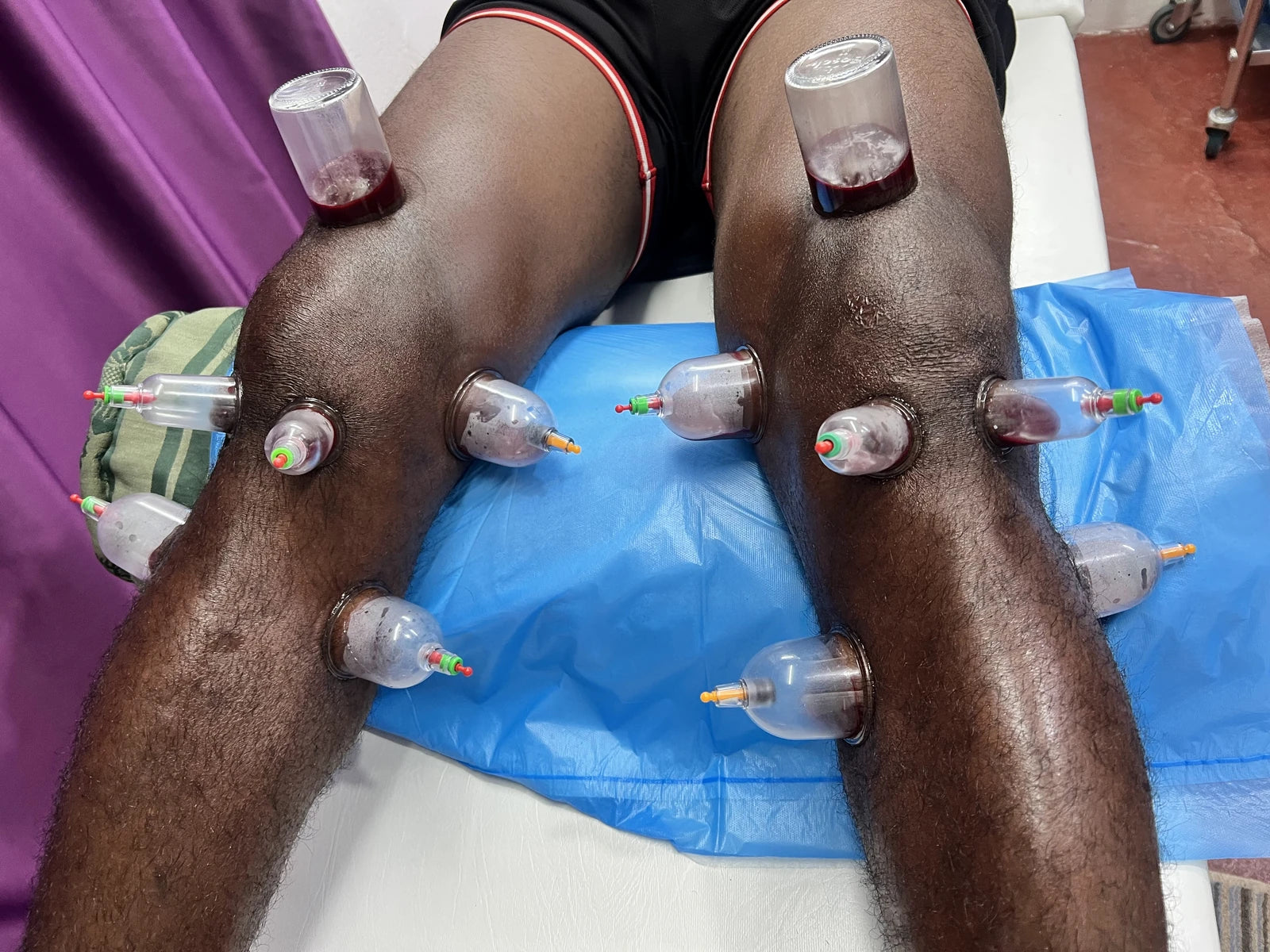 Rashid Hijama cupping Services, Johannesburg South Africa